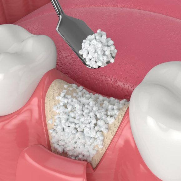 Bone Grafts