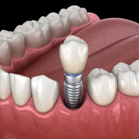 Dental Implants