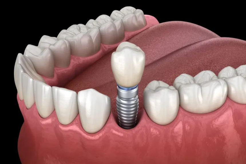 Dental Implants
