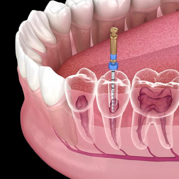 Root Canal