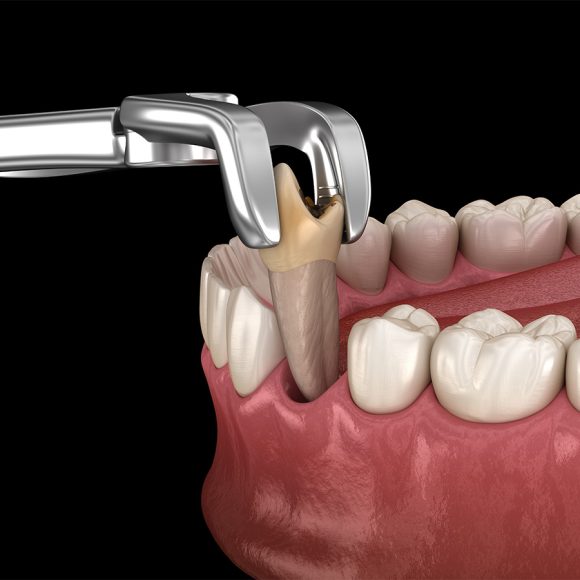 Extractions (Standard)