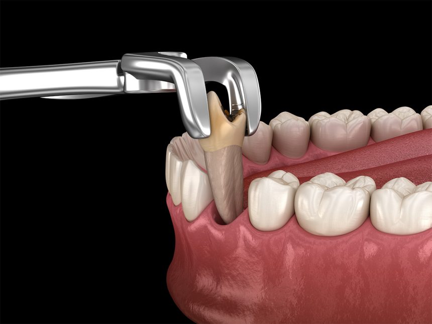 Extractions (Standard)