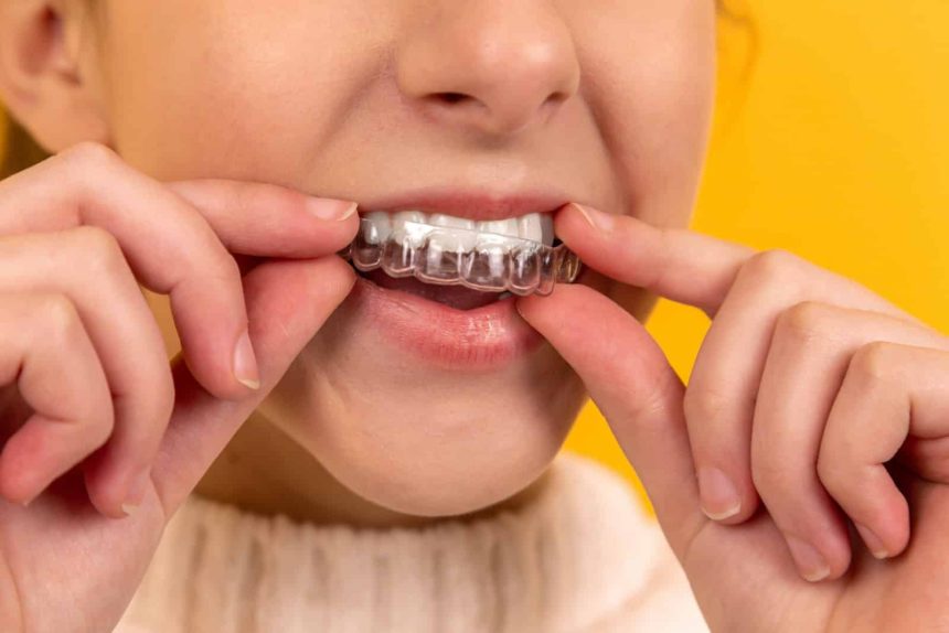 TMJ (Temporomandibular Joint) Dental Splint