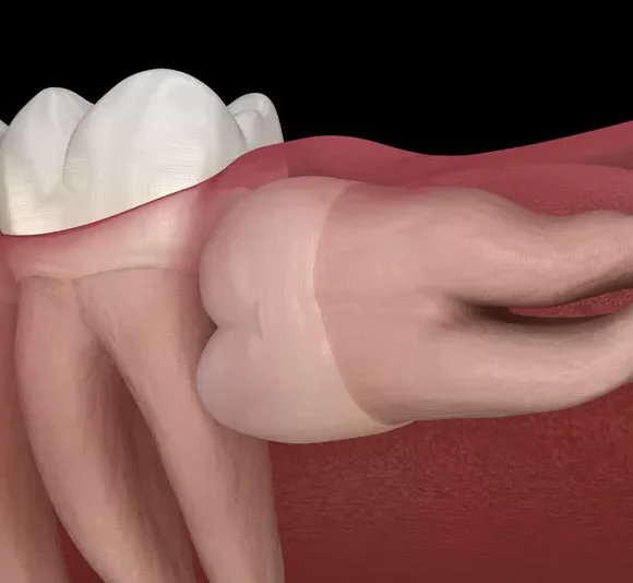 Wisdom Teeth (+Full Bony Impacted Extraction)