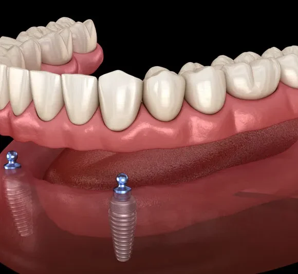 Hybrid (Implant-Supported Dentures or Bridges)