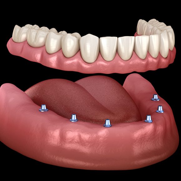 Overdenture