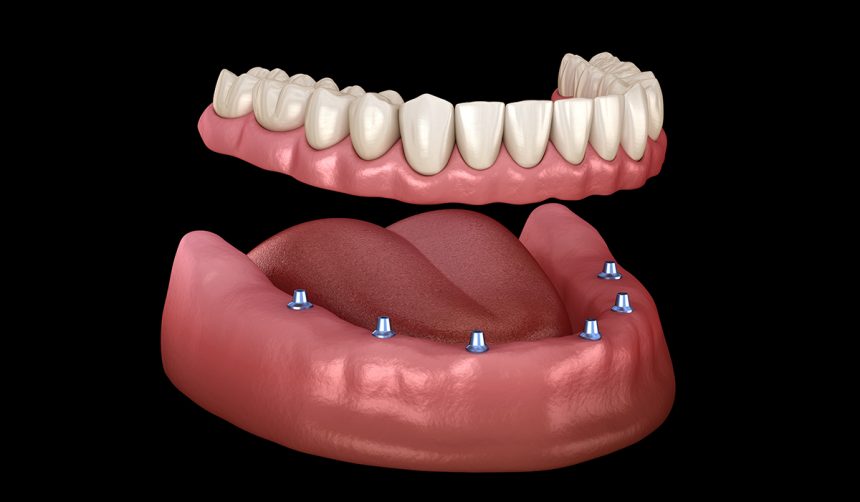 Overdenture