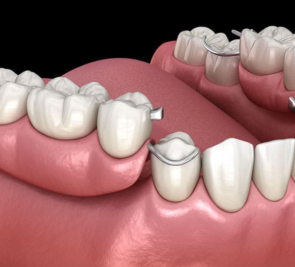 Removable Denture
