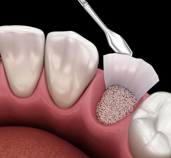 Bone Grafts