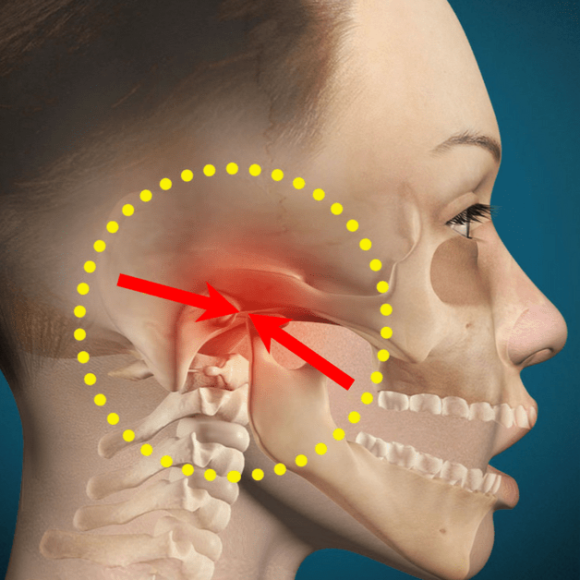 TMJ (Temporomandibular Joint) Dental Splint