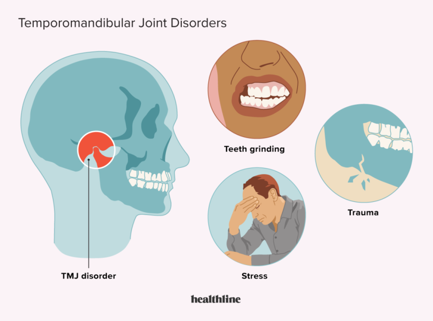 TMJ (Temporomandibular Joint) Dental Splint