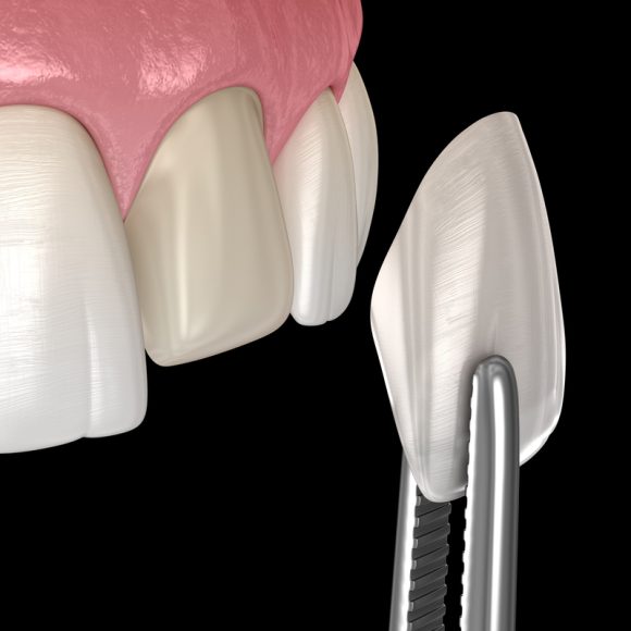 Veneers