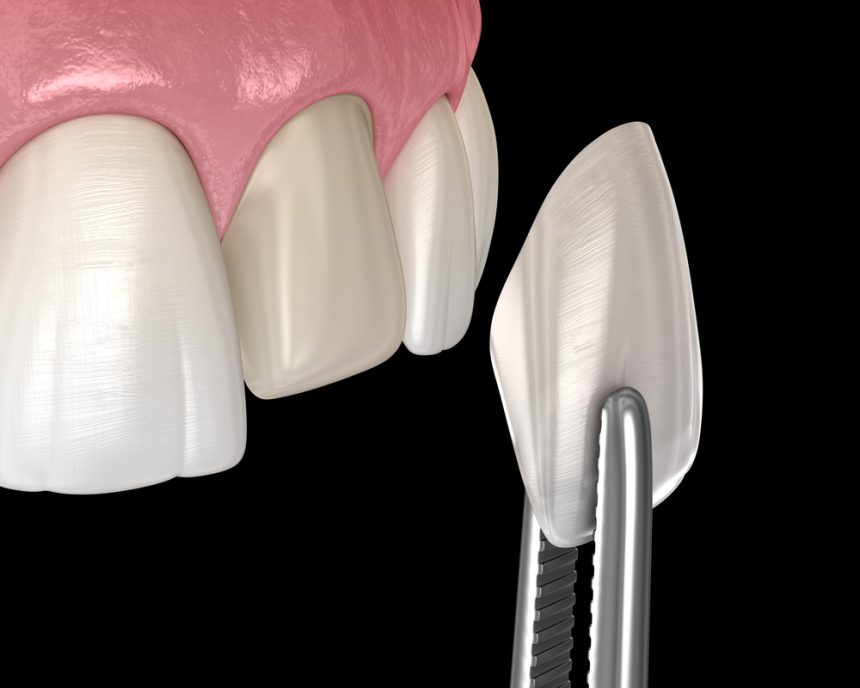 Veneers